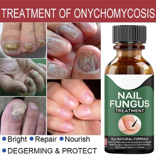 Nail Fungus Treatment Serum 10ml – Fast & Effective Fungal Solution
