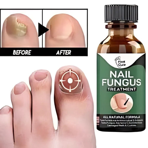 Nail Fungus Treatment Serum 10ml – Fast & Effective Fungal Solution